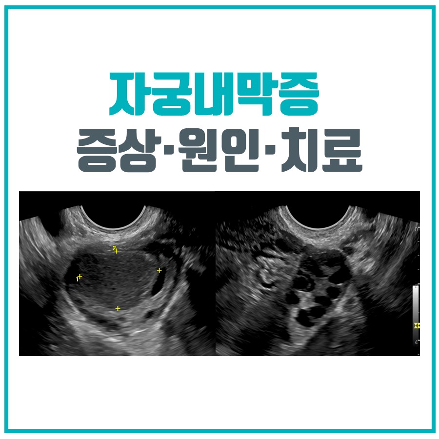 자궁내막증, 난소 자궁내막종? 증상, 원인 및 치료법 정리해드립니다