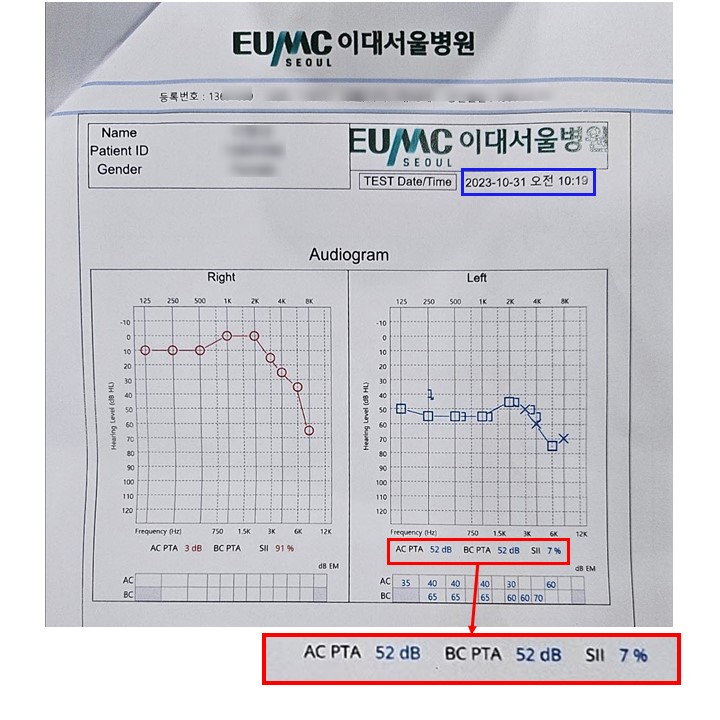 이대서울병원 청력검사 결과지 이미지로, 오른쪽과 왼쪽 귀의 주파수별 청력 수준 그래프와 함께 왼쪽 귀의 AC PTA, BC PTA, SII 수치가 표시되어 있다.