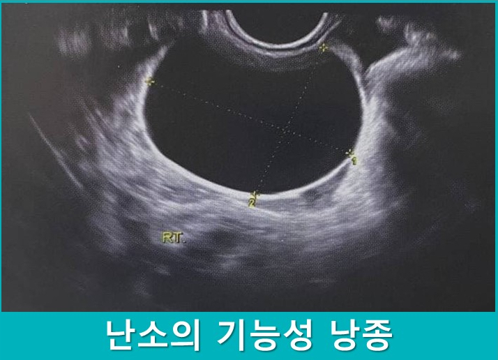 난소의 기능성 낭종을 보여주는 초음파 사진 — 초음파 정밀 진단 | 서울 바로한의원 초음파 약침·도침·침도