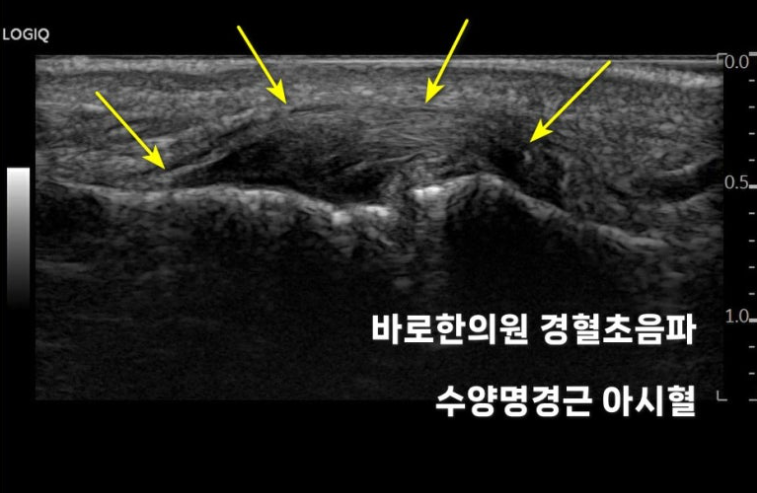 노란색 화살표로 특정 부위가 표시된 손가락 경혈 초음파 사진