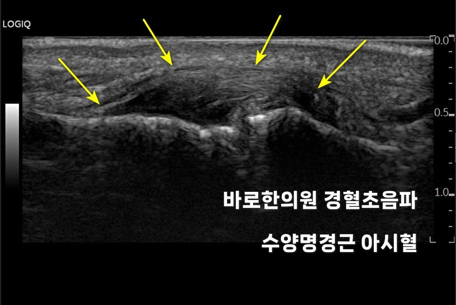 손가락 인대 초음파 사진으로, 노란색 화살표가 인대 부위를 가리키고 있다.