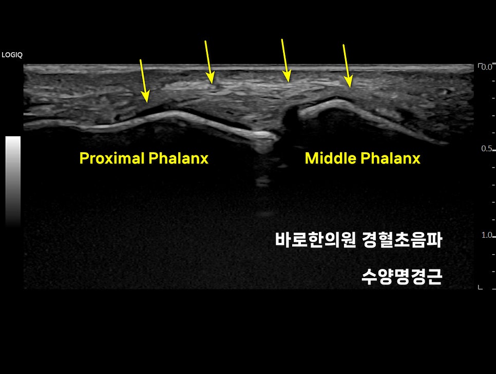 손가락 관절의 초음파 영상으로, 근위지골과 중위지골이 보이며 노란색 화살표가 인대 부위를 가리키고 있다.