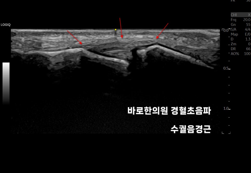 손가락 관절을 촬영한 초음파 이미지로, 붉은색 화살표가 특정 부위를 지시하고 있습니다.