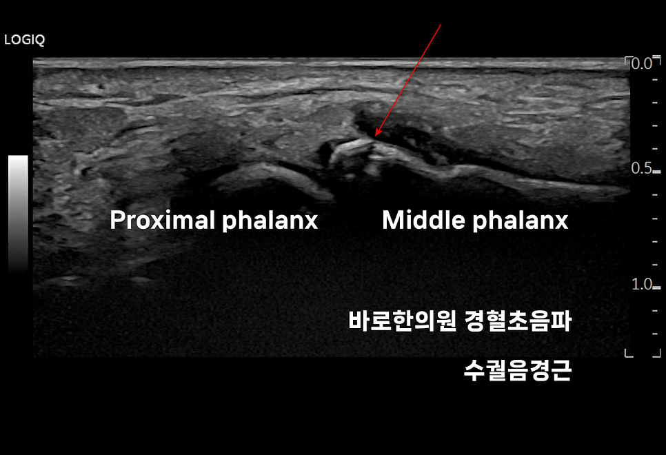 손가락 근위지골과 중위지골 사이의 초음파 영상으로, 붉은 화살표가 가리키는 부위에 골절이 보입니다.