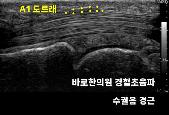 손가락 A1 도르래와 수궐음 경근 부위를 나타내는 초음파 사진