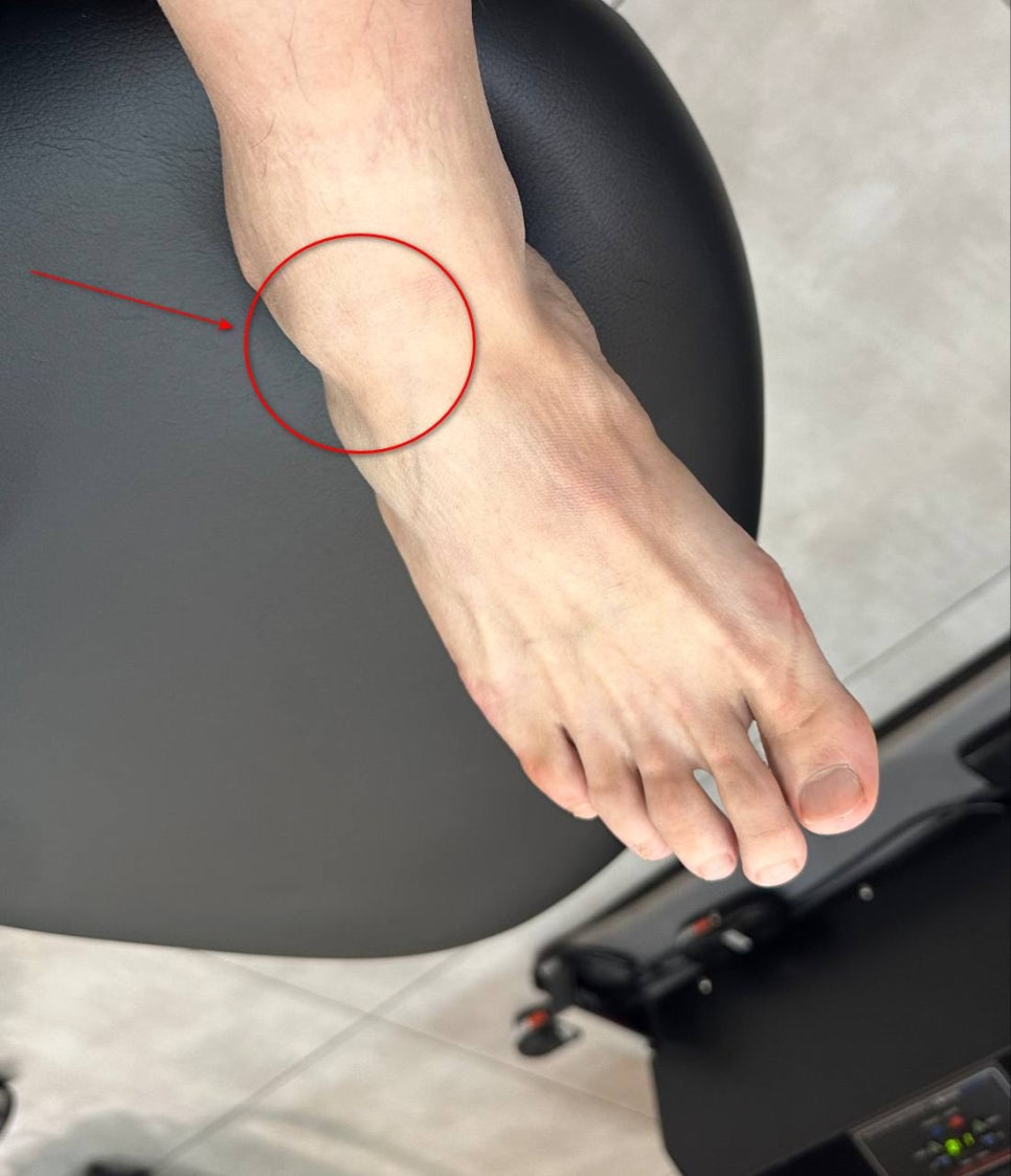 발등과 발목 부위에 부기가 있는 모습을 빨간색 원과 화살표로 표시한 사진 — 서울 바로한의원 초음파 약침·도침