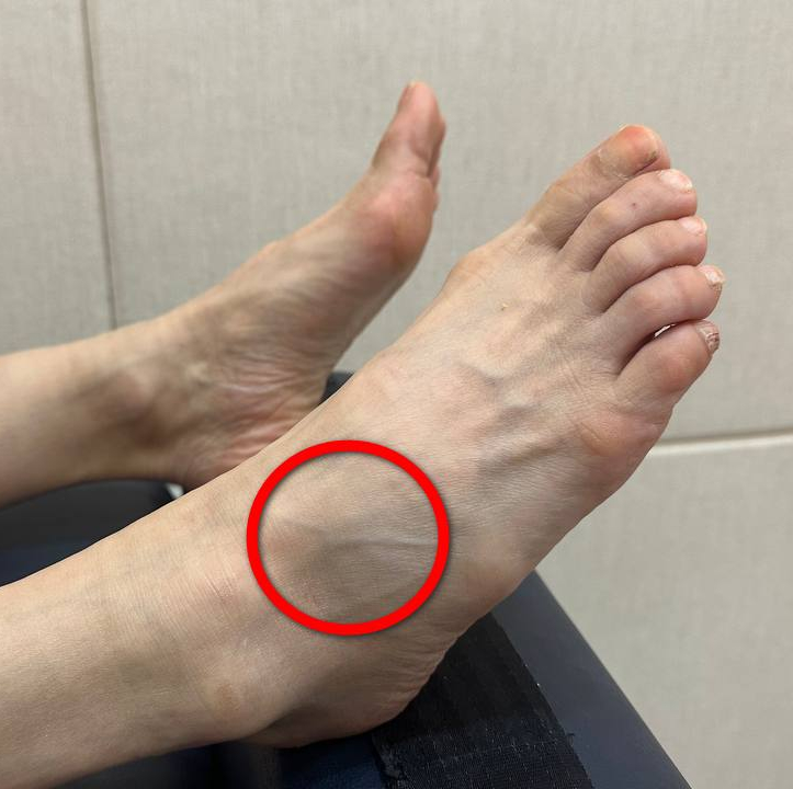 발등에 붉은 원으로 표시된 돌출된 부분이 있는 발 사진
