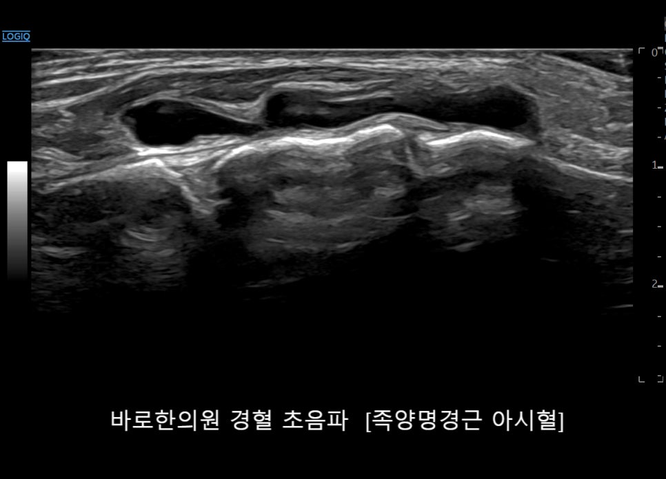 발등 부위의 초음파 영상으로, 액체로 채워진 것으로 보이는 구조물이 보인다.