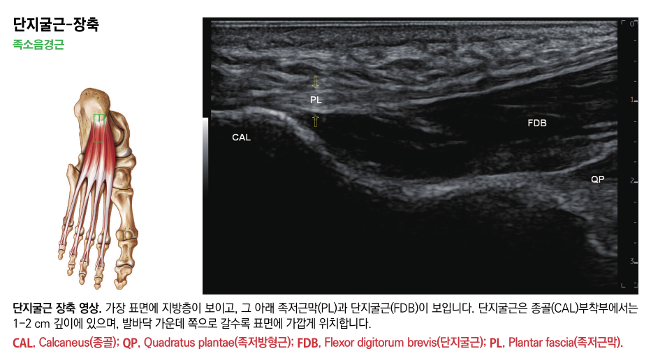 발 해부학 그림과 발바닥 초음파 영상으로, 초음파 영상에는 종골, 족저근막, 단지굴근이 표시되어 있다.