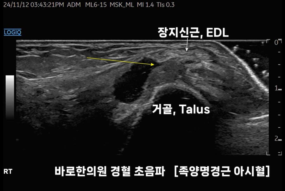 발등 부위 초음파 영상에서 장지신근과 거골 주변에 노란색 화살표로 표시된 물혹이 보인다.