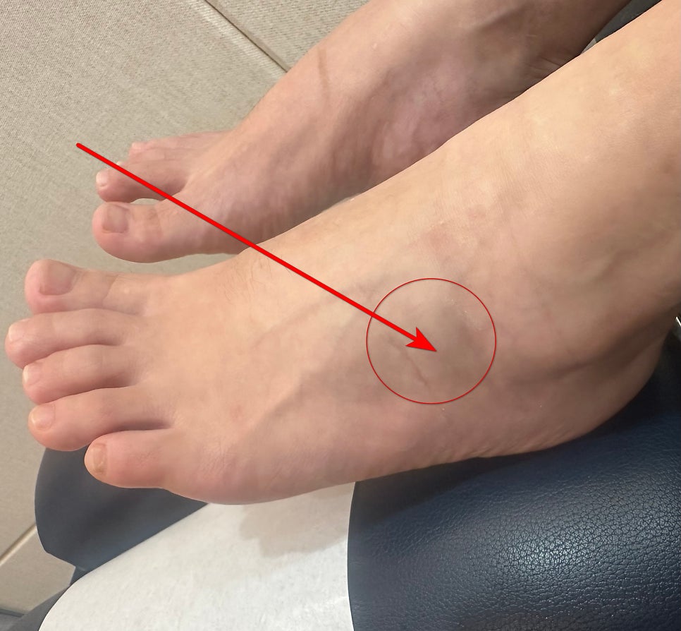 발등에 붉은 화살표와 원으로 표시된 부위가 있는 발 사진.