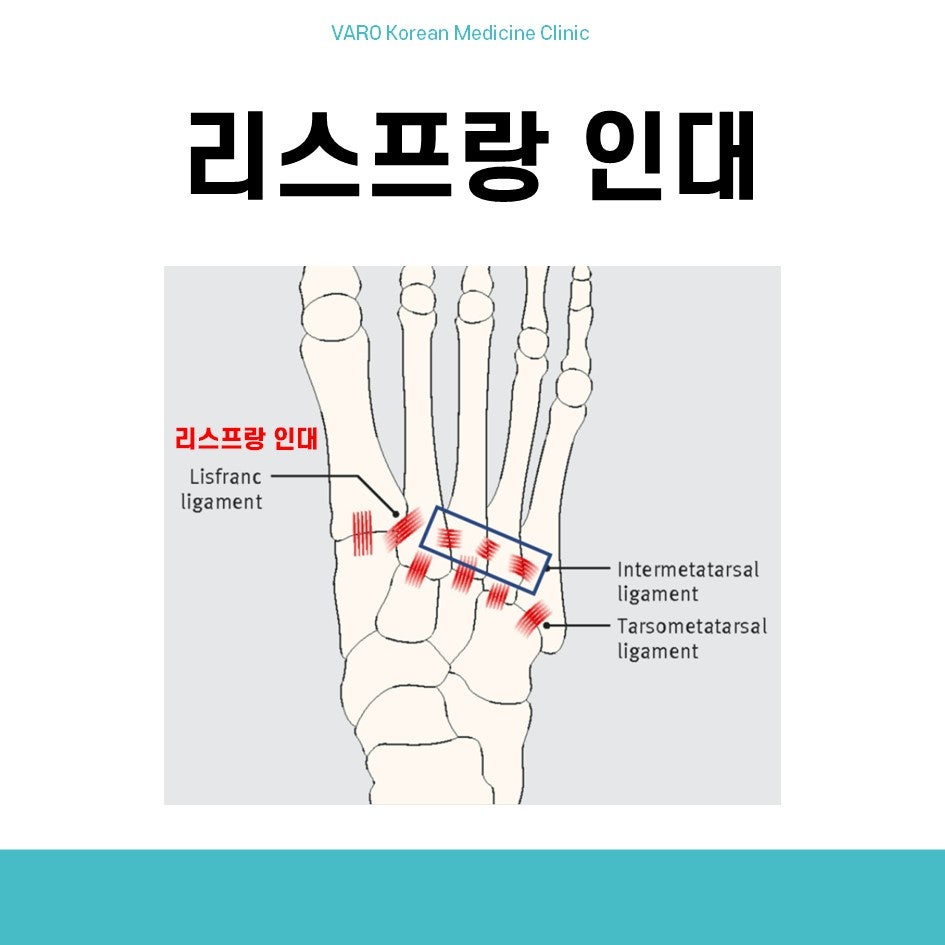 발의 리스프랑 인대와 주변 인대 위치를 보여주는 해부학적 그림입니다.