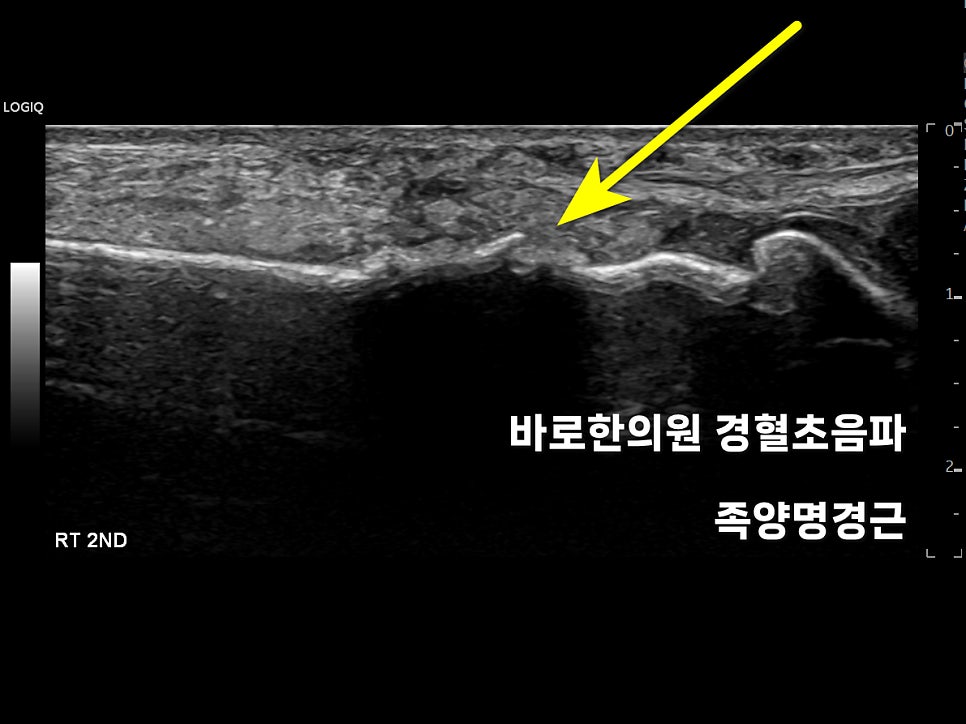 발등 중족골 부위의 초음파 영상으로, 노란색 화살표가 가리키는 부분이 보인다.