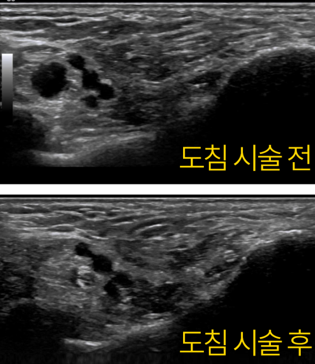 도침 시술 전후를 비교하는 발 부위 초음파 사진