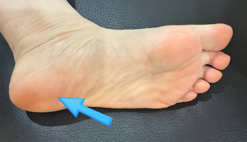 발바닥 뒤꿈치 부위를 파란색 화살표가 가리키는 모습 — 서울 바로한의원 초음파 약침·도침