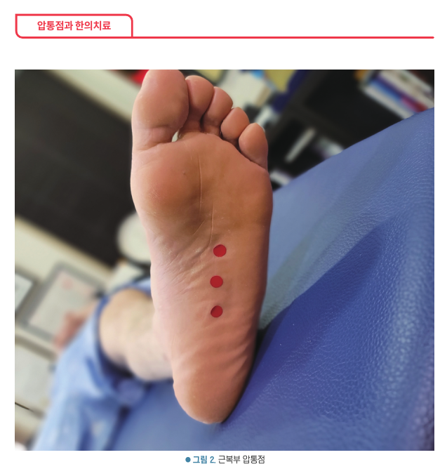 발바닥에 압통점 세 곳이 빨간 점으로 표시된 모습