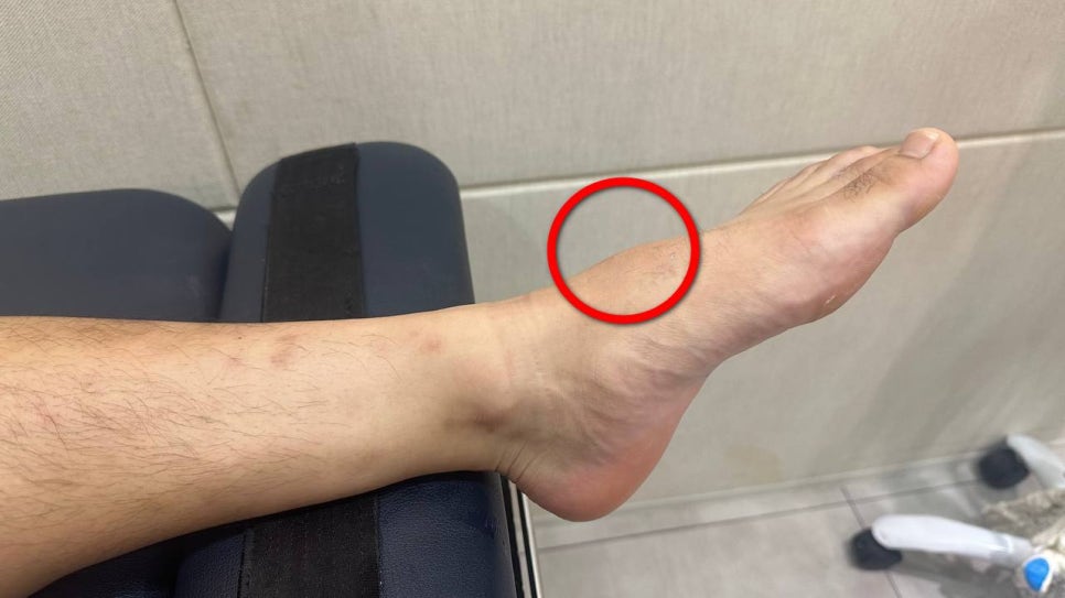 발등에 빨간 원으로 표시된 부위가 있는 발 사진