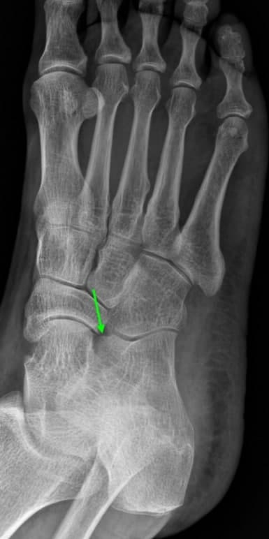 발 X-ray 사진에서 녹색 화살표가 발목 부위의 작은 뼈를 가리키고 있습니다.