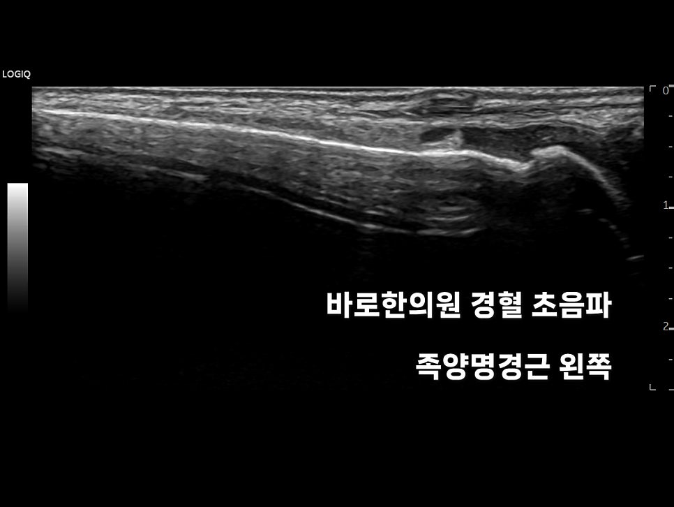 왼쪽 족양명경근 부위의 초음파 영상