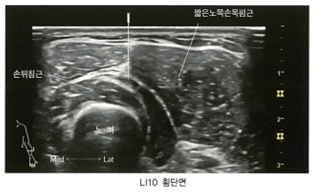 팔의 LI10 경혈 부위 초음파 이미지로, 손뒤침근과 짧은노쪽손목폄근, 노뼈가 보이며 침이 삽입되어 있다.