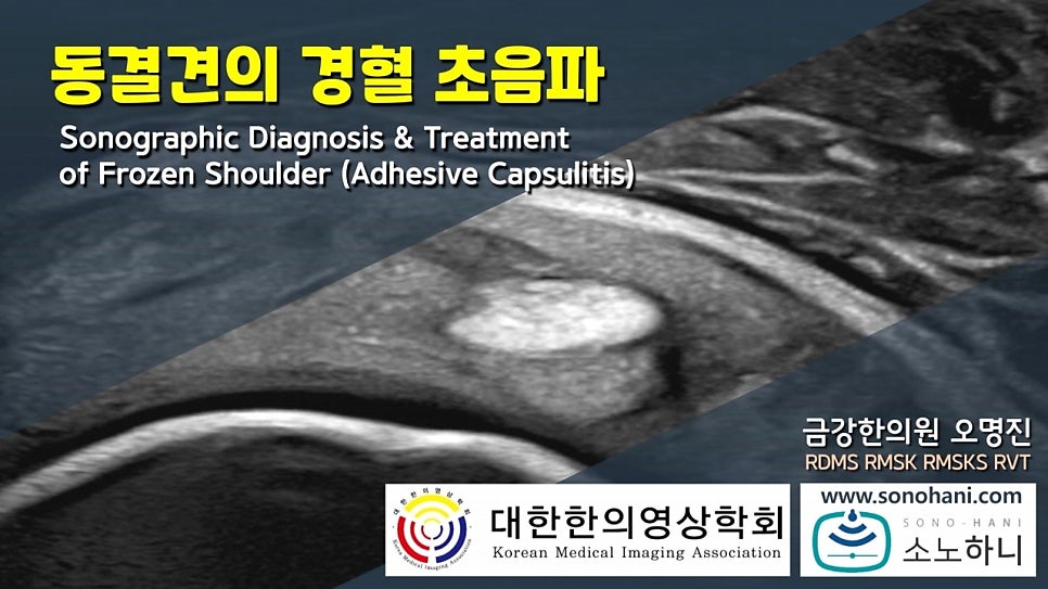 동결견의 경혈 초음파라는 제목과 함께 어깨 초음파 영상이 배경으로 보이는 이미지.
