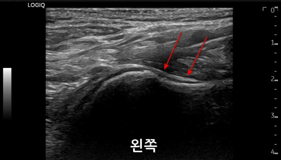 어깨 관절 초음파 사진으로, 빨간 화살표가 특정 부위를 가리키고 있으며 '왼쪽'이라는 글자가 보인다.