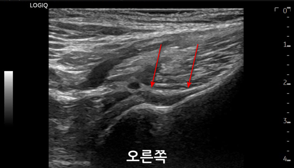 오른쪽 어깨 부위 초음파 영상에 빨간 화살표가 표시되어 있다.