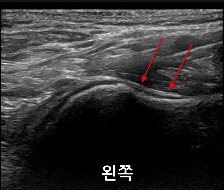 어깨 관절 초음파 사진으로, 빨간 화살표가 관절낭 부위를 가리키고 있다.