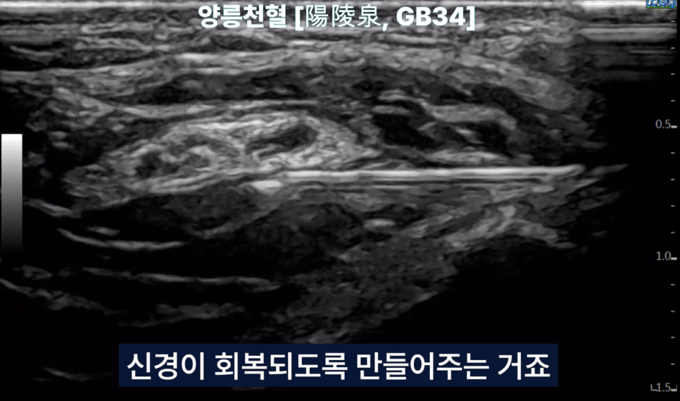 초음파 화면에서 양릉천혈(GB34) 부위에 약침 시술 중인 모습