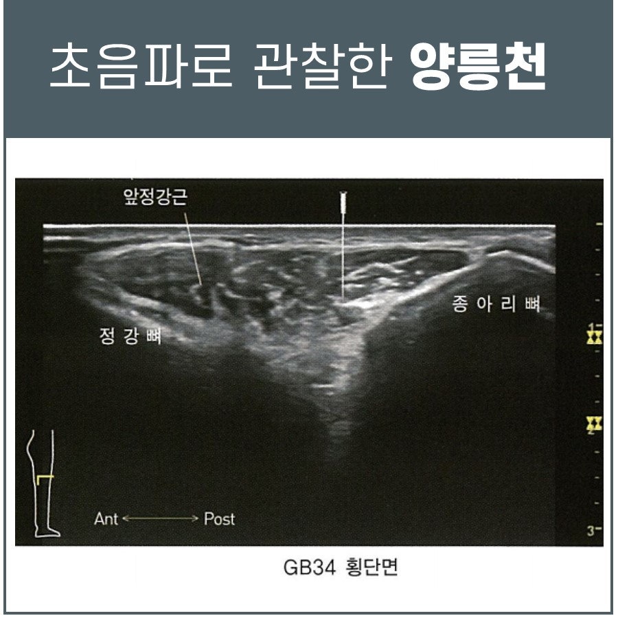 초음파로 관찰한 양릉천 혈자리 주변의 정강뼈, 종아리뼈, 앞정강근을 보여주는 이미지