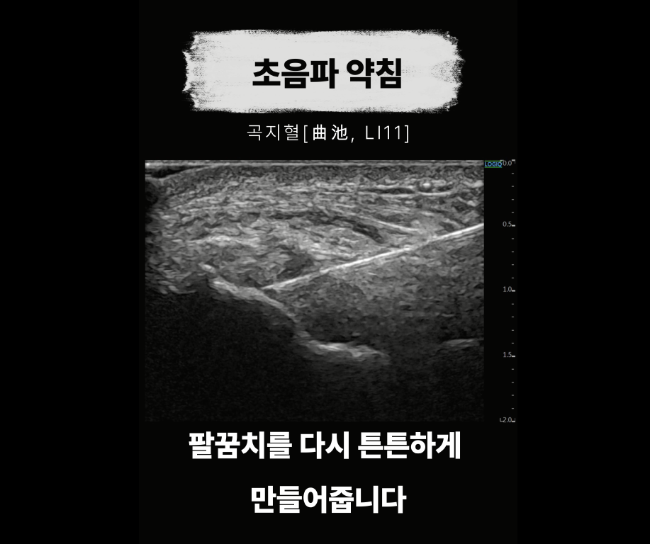 초음파 화면에 곡지혈 부위에 침이 삽입된 모습
