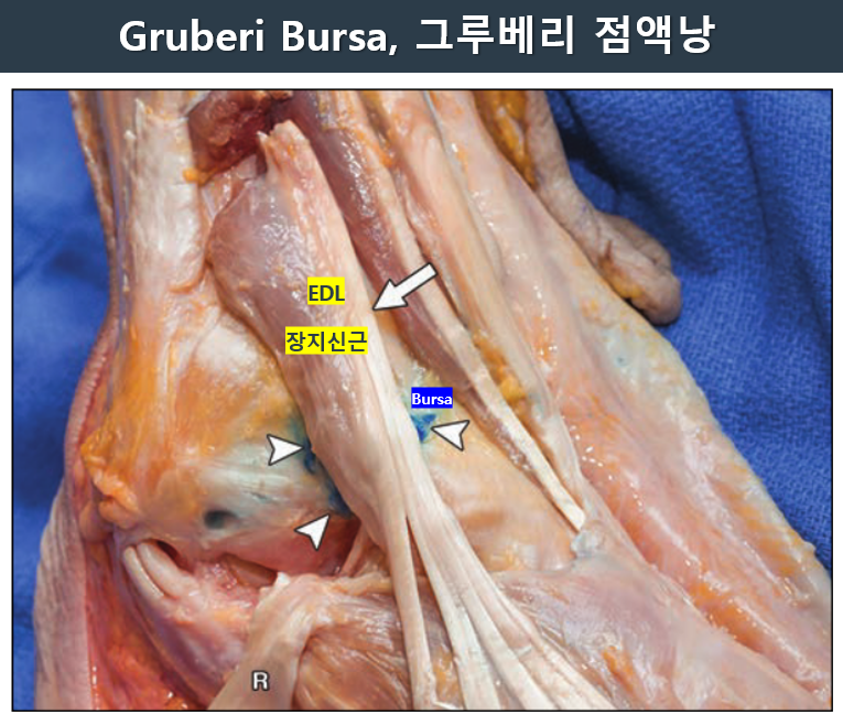 발 해부 사진에서 그루베리 점액낭과 장지신근을 표시한 모습