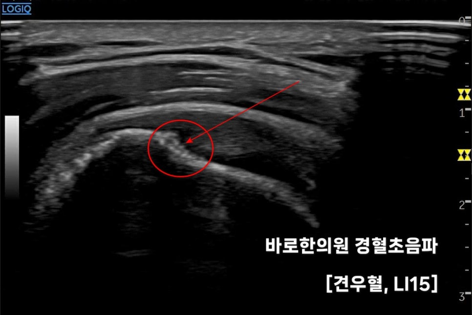 견우혈(LI15) 부위의 초음파 영상으로, 붉은 원과 화살표가 특정 부위를 가리키고 있다.