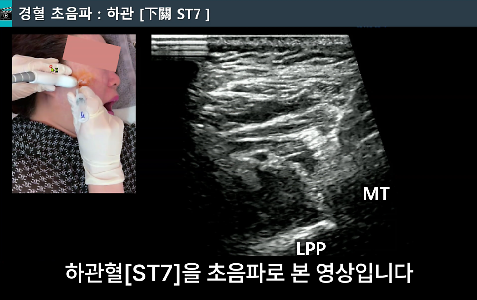 초음파 기기로 하관혈(ST7) 부위를 보며 약침 시술을 받는 사람의 모습과 해당 부위의 초음파 영상