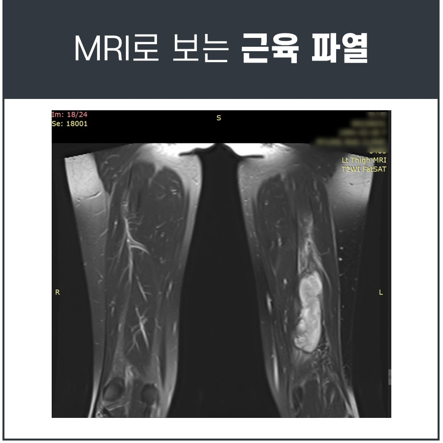 MRI로 본 왼쪽 허벅지 햄스트링 근육 파열 부위