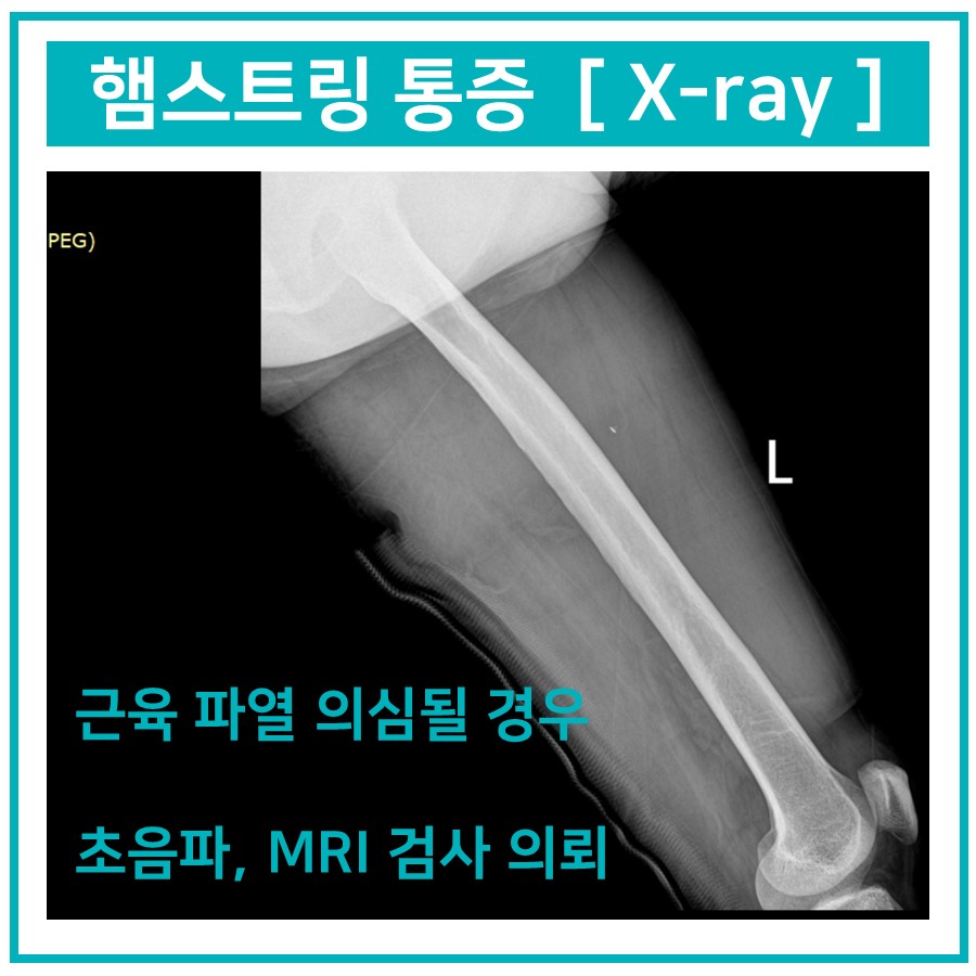 다리 뼈의 X-ray 사진과 햄스트링 통증, 검사 안내 문구가 함께 있는 이미지 — 서울 바로한의원 초음파 약침·도침