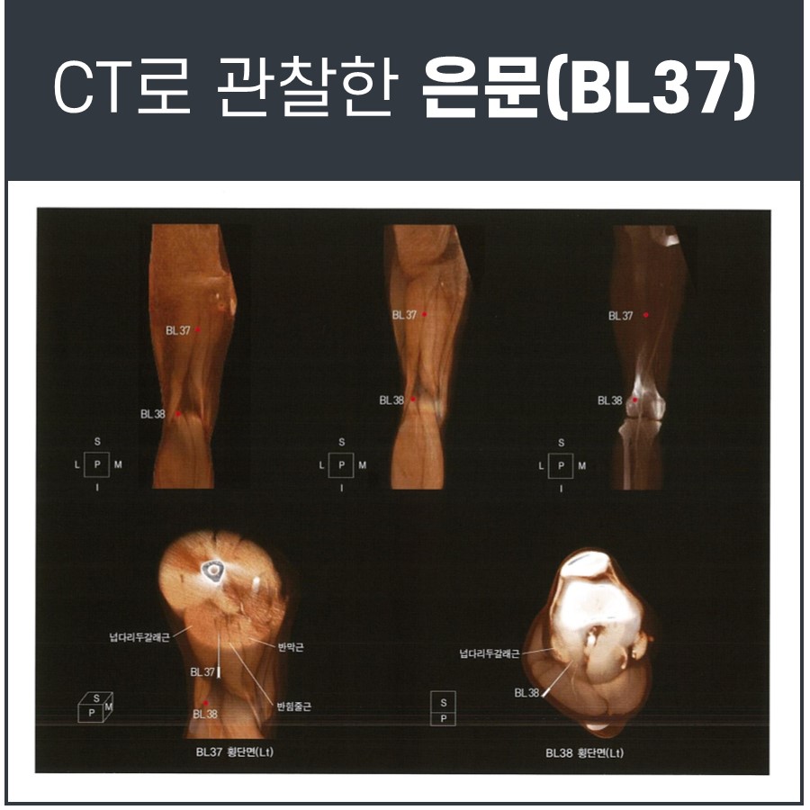 허벅지 뒤쪽의 은문(BL37)과 위양(BL38) 혈자리를 CT로 관찰한 이미지