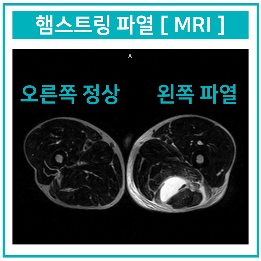 햄스트링 MRI 사진으로 오른쪽 정상과 왼쪽 파열된 부위를 비교한 이미지 — 서울 바로한의원 초음파 약침·도침