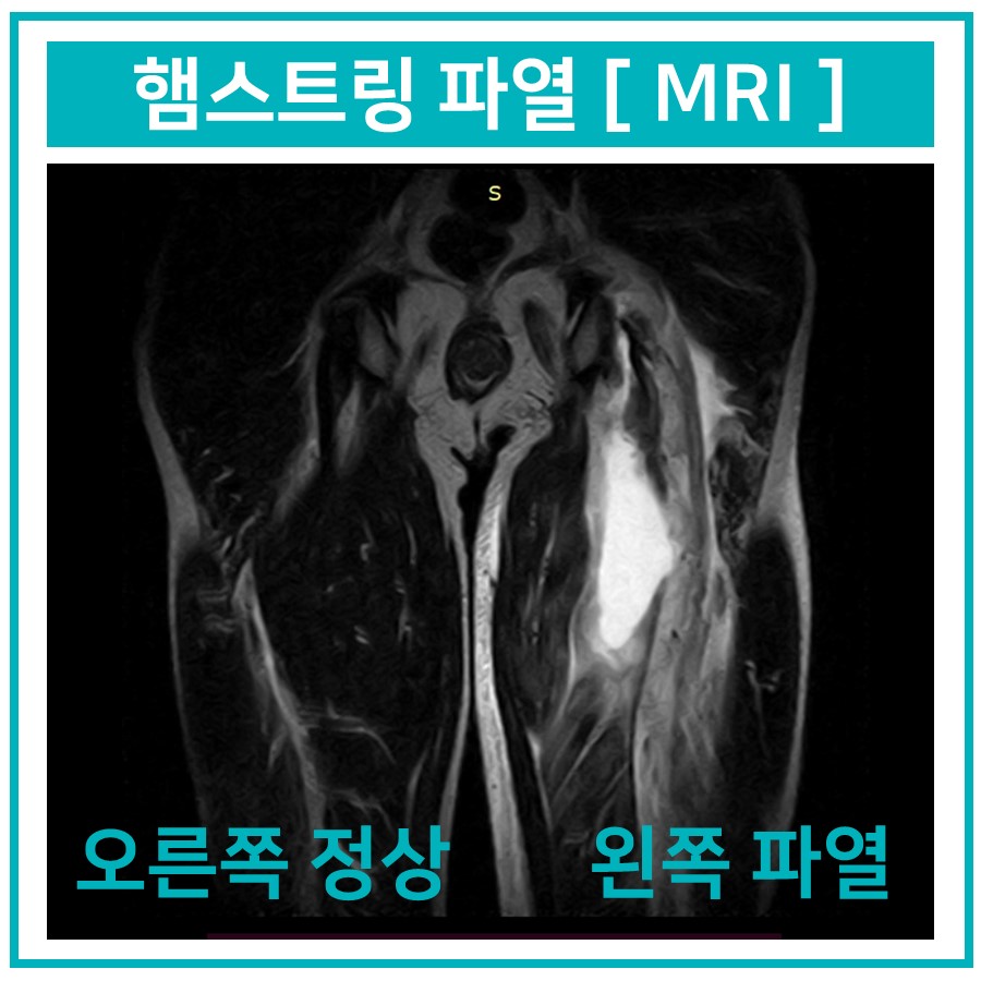 햄스트링 파열을 보여주는 MRI 사진으로, 오른쪽은 정상이고 왼쪽은 파열된 모습이다 — 서울 바로한의원 초음파 약침·도침