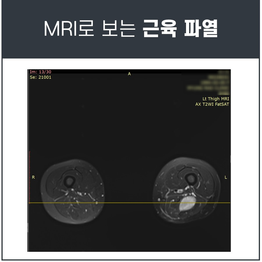 왼쪽 허벅지 근육이 파열되어 밝게 보이는 MRI 이미지