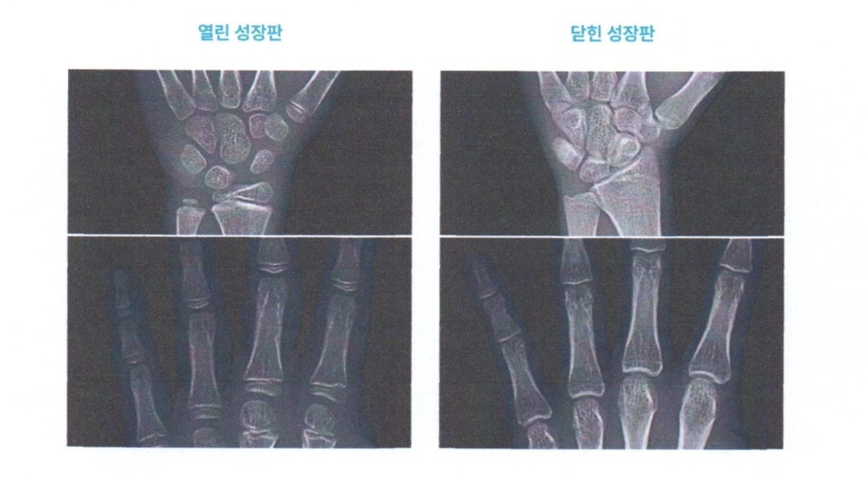 열린 성장판과 닫힌 성장판을 보여주는 두 개의 손 엑스레이 사진.
