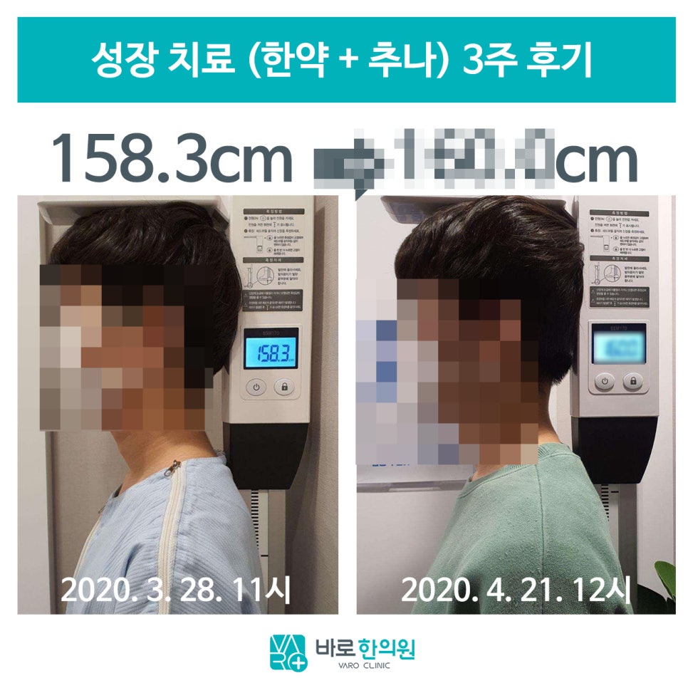 한의원에서 키 성장 치료 전후를 비교한 사진으로, 왼쪽은 158.3cm, 오른쪽은 160.0cm로 측정된 모습입니다.