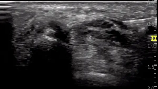 초음파로 본 연부 조직과 침 — 초음파 유도하 약침 시술 | 서울 바로한의원