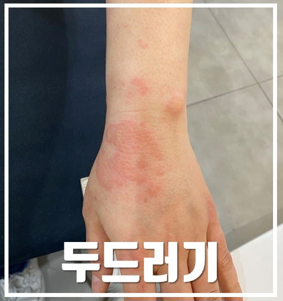 손목과 손등에 붉게 부어오른 두드러기가 나타난 모습 — 서울 바로한의원 초음파 약침·도침