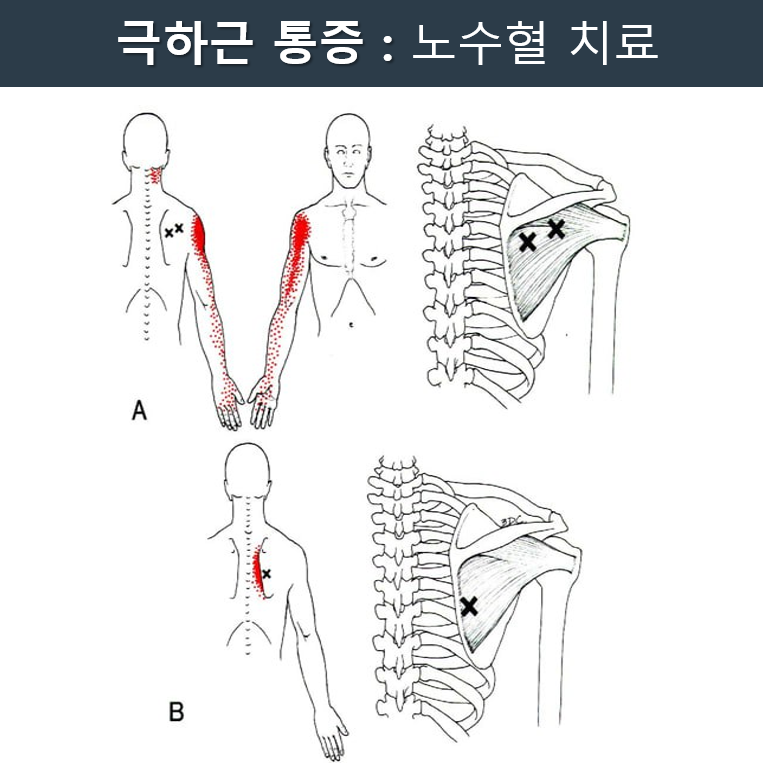 극하근 통증 유발점과 방사통을 나타내는 인체 해부도