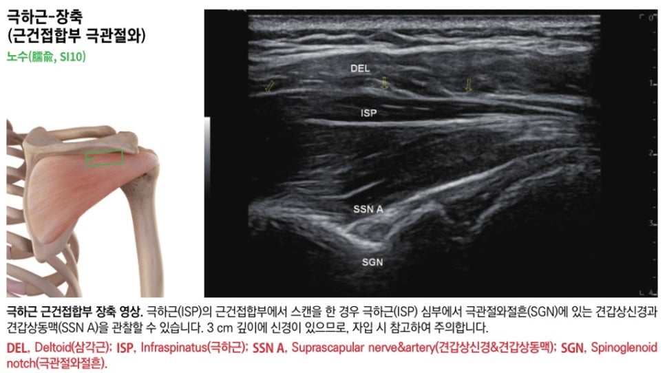 어깨 해부학 그림과 극하근 건근접합부의 초음파 영상. 삼각근, 극하근, 견갑상신경 및 동맥, 극관절와절흔이 표시되어 있다.