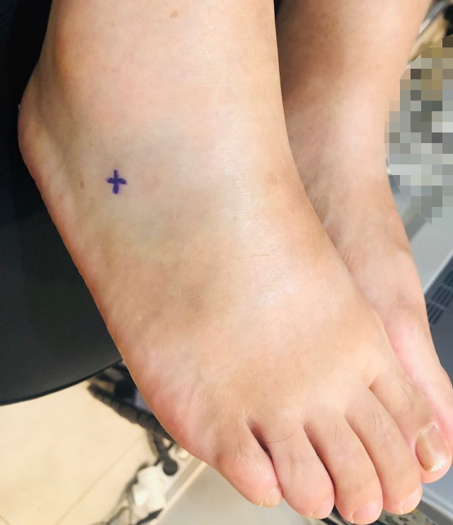 보라색 십자 표시가 있는 부어오른 발등과 발목 부위.
