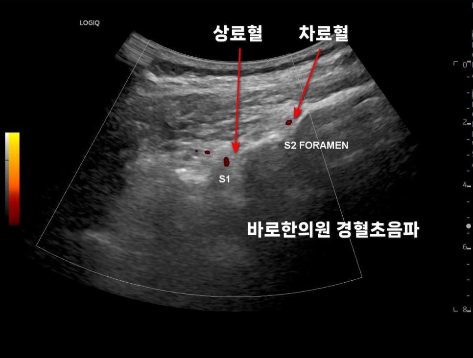 과민성 방광 증후군, 만성 방광염 원인 치료? <이것>모르면 후회합니다