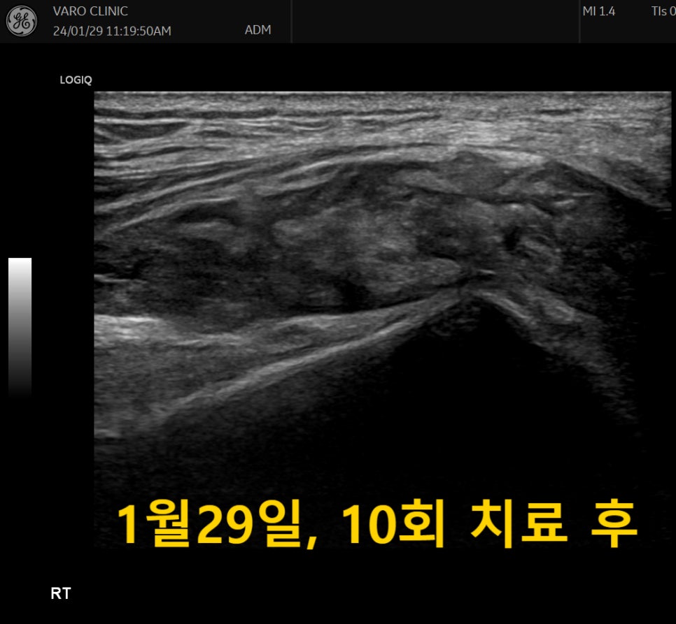 10회 치료 후 무릎 관절 부위를 촬영한 초음파 사진