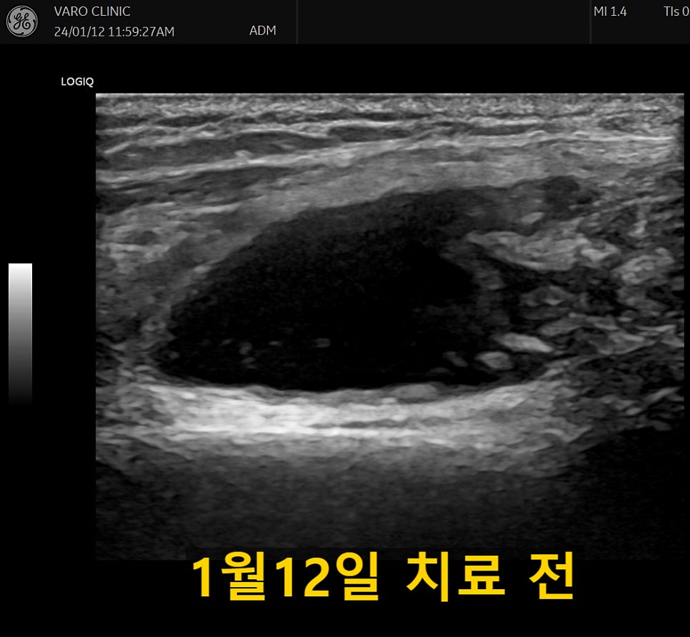무릎에 물이 찬 상태를 보여주는 초음파 사진. 1월 12일 치료 전.